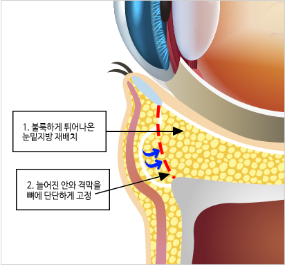 격막강화