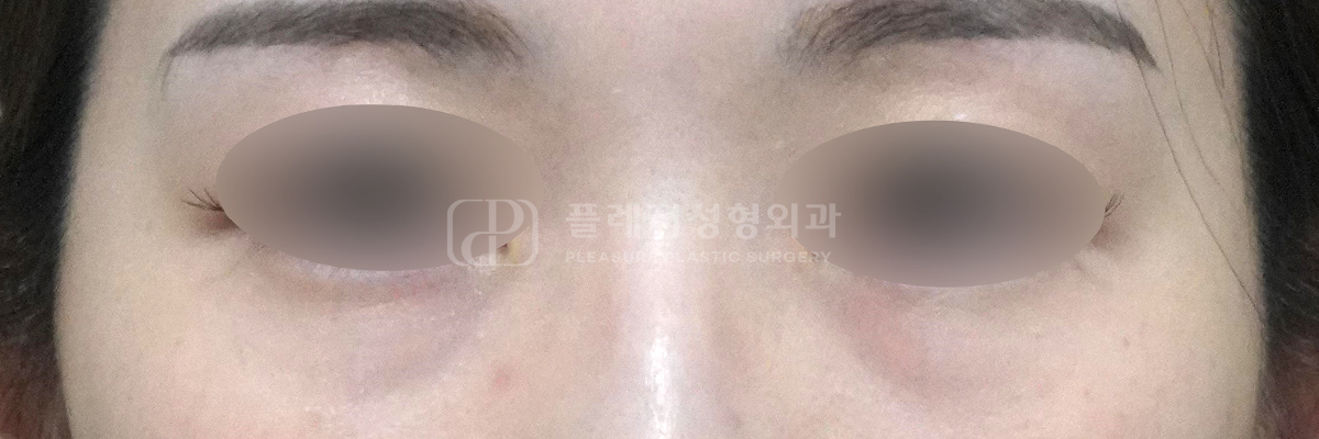 지방 함몰형 다크서클