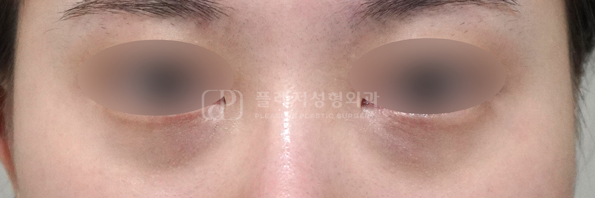 색소 침착형 다크서클