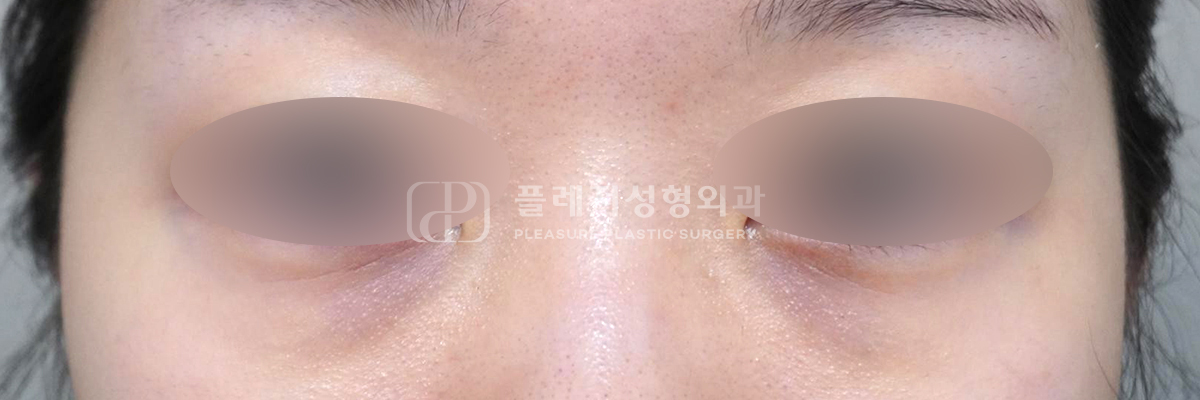 혈관 비침형 다크서클