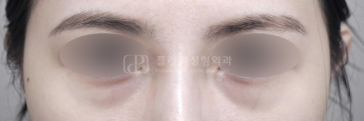 복합형 다크서클 수술 전