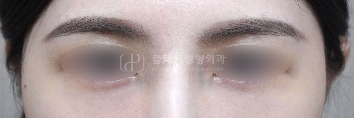 복합형 다크서클 수술 후 (케어 후)
