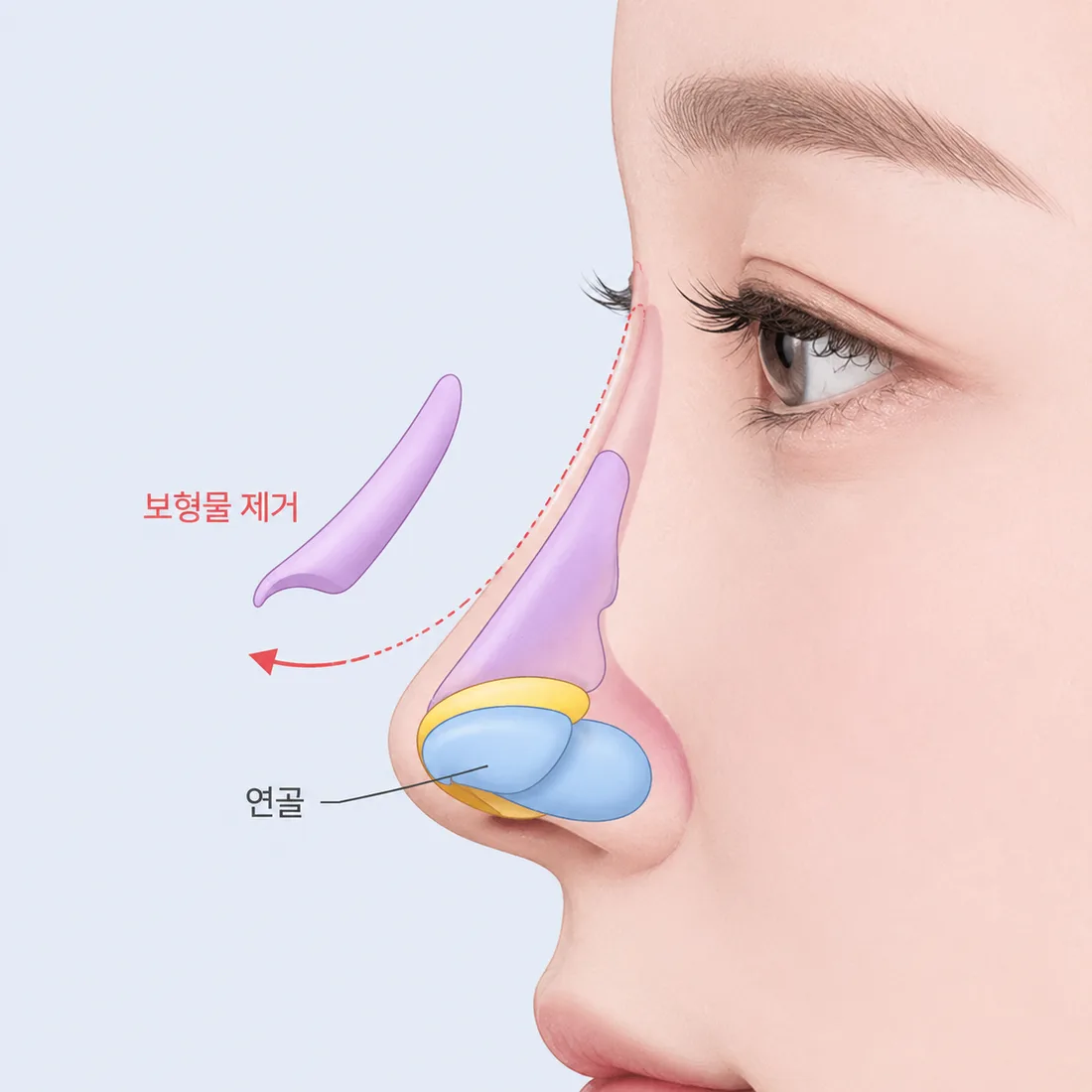 비개방 코성형 케이스5