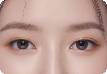 눈재수술 2