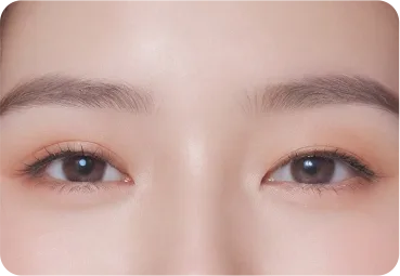 눈재수술 3