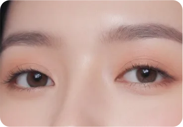 눈재수술 4