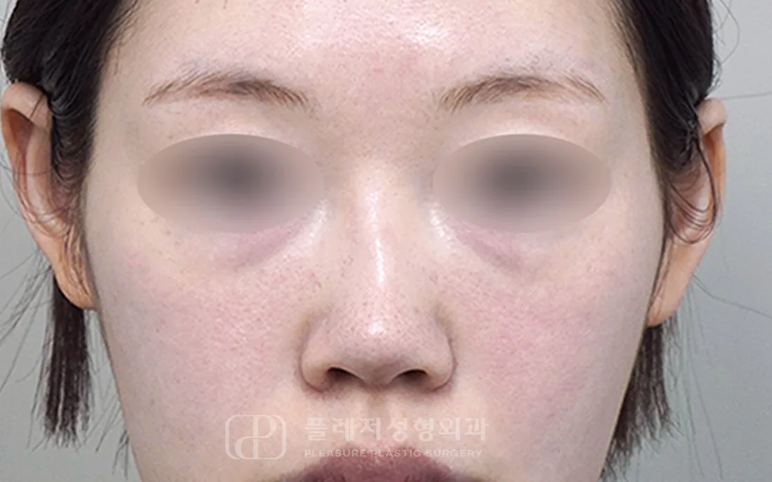 유형별 코성형 휜코