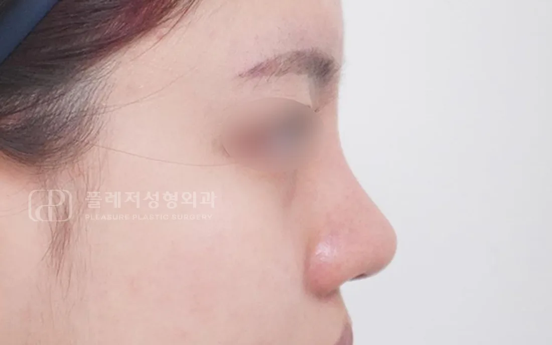 유형별 코성형 2