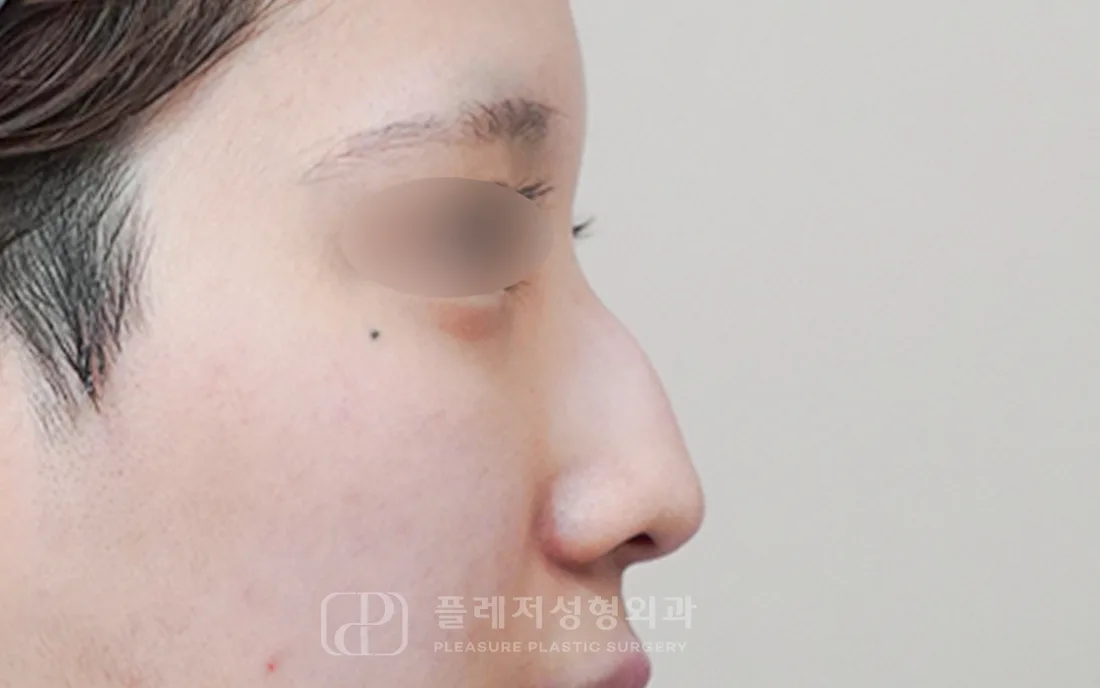 유형별 코성형 5