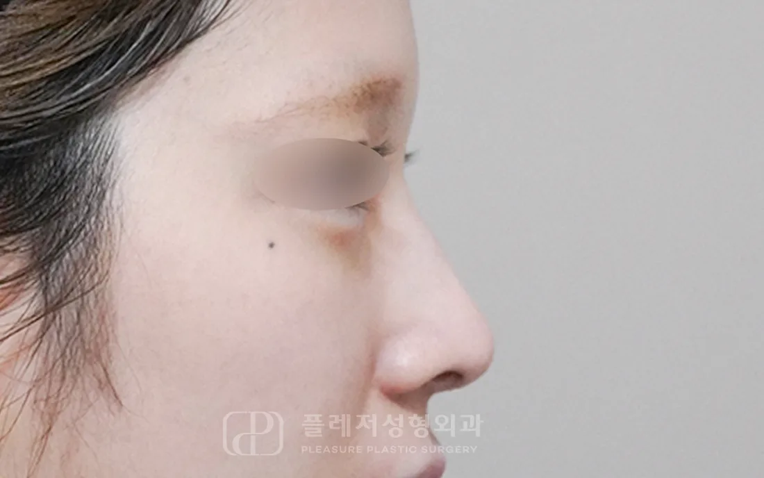 유형별 코성형 6