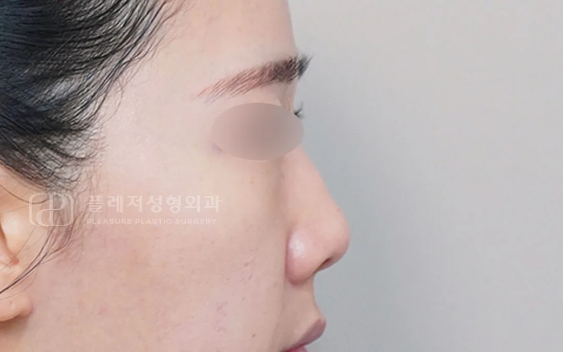 유형별 코성형 7
