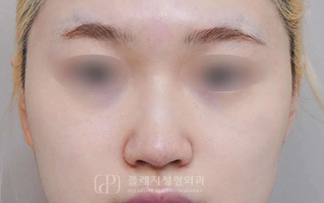 유형별 코성형 9