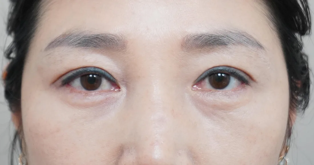 상안검 4