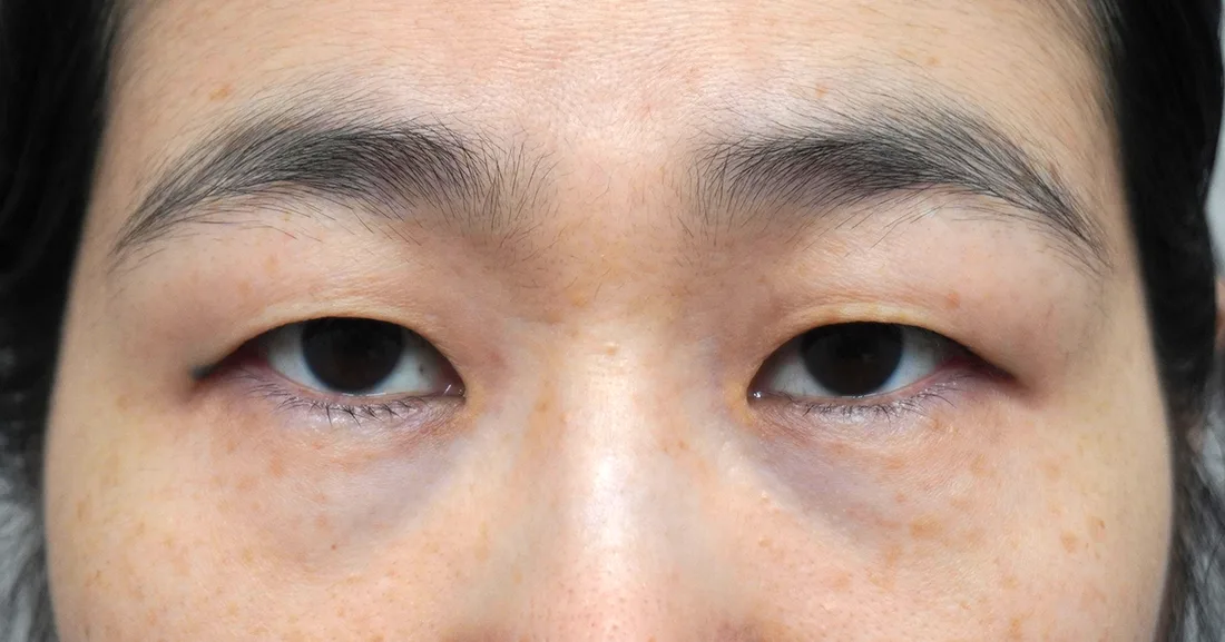 상안검 7