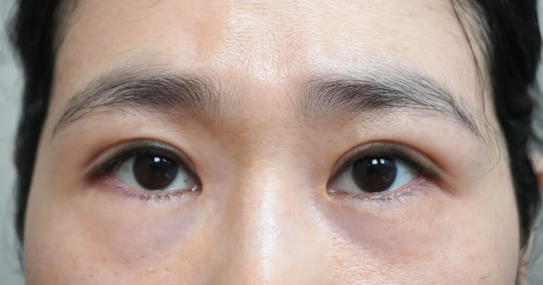 상안검 8