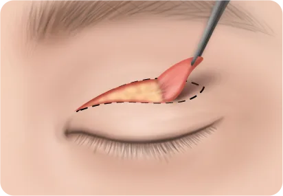 상안검 과정