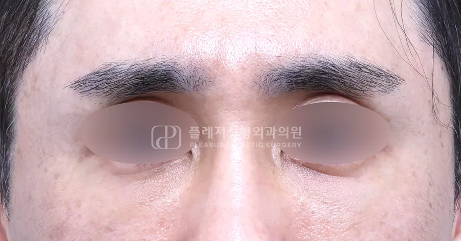 눈밑지방이식 전후