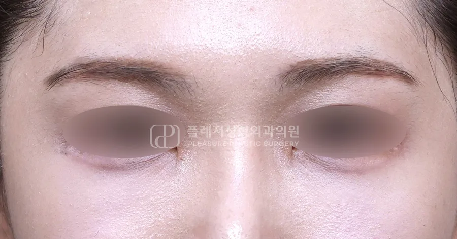눈밑지방이식 전후