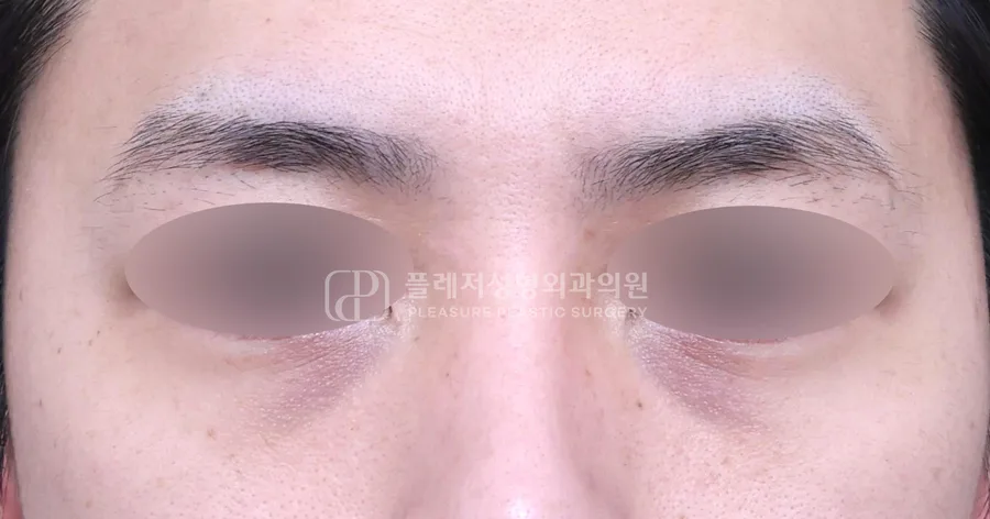 눈밑지방이식 전후