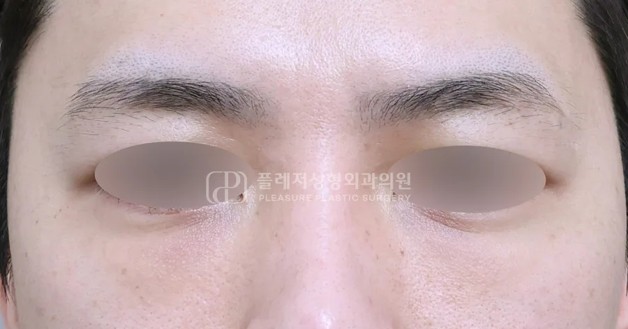 눈밑지방이식 전후