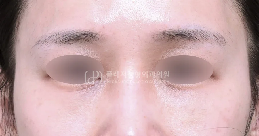 눈밑지방이식 전후