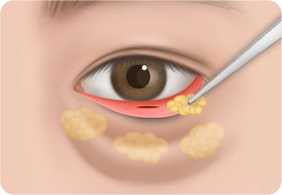 지방 채취 및 정제