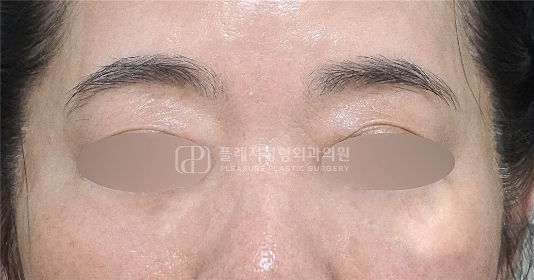 Case 02 After