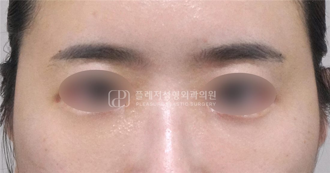 Case 03 After