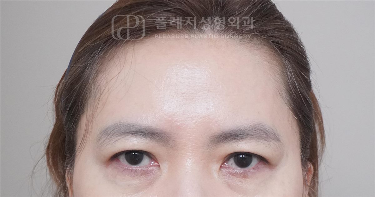 눈썹 처짐 BEFORE