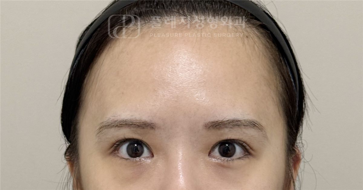 눈꺼풀 무거움 BEFORE